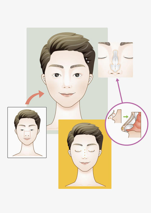 上海玫瑰医疗美容医院隆鼻怎么样?为您解析