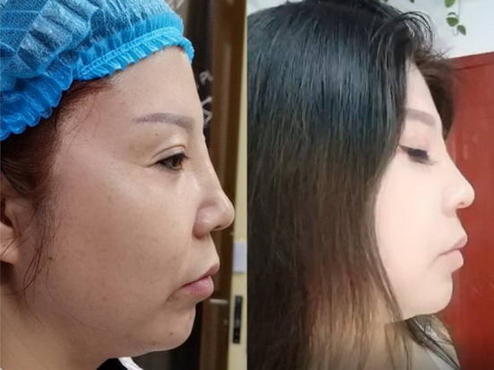 艾玛李方奇院长:骨粉的这些事儿,你一定要了解!