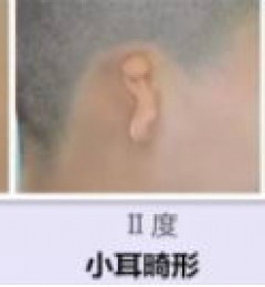 余文林:小耳畸形耳再造手术几岁做比较好？