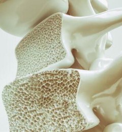 骨质疏松多发于女性 荷尔蒙分泌量在作怪