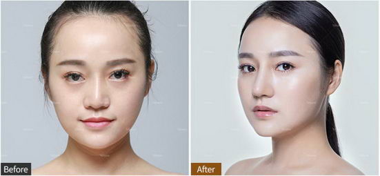 鼻部缺陷隆鼻能解决吗?重庆当代埃菲尔®美鼻怎么样?