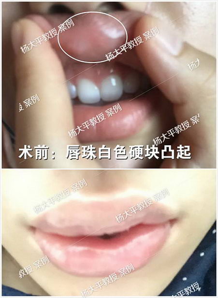 【杨大平教授诊间日记】又一位美容院“黑针”受害者