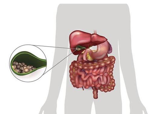 胆固醇高容易形成胆结石 喝黄耆荷叶消积茶可预防