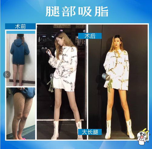 最有效的减肥瘦身方式是吸脂