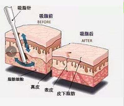 最有效的减肥瘦身方式是吸脂