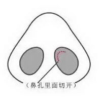 院长王军异体骨隆鼻中的黑科技