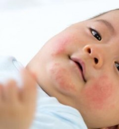 儿童急性荨麻疹 可能由霉浆菌引起
