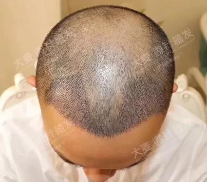 脱发20年植发能治好吗？青岛大麦植发真实案例分享！