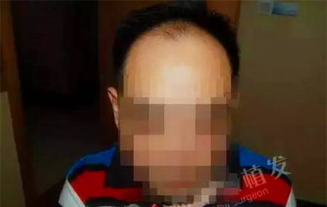 青岛大麦头发加密植发术后效果，帮助赵先生摆脱头发稀疏的烦恼