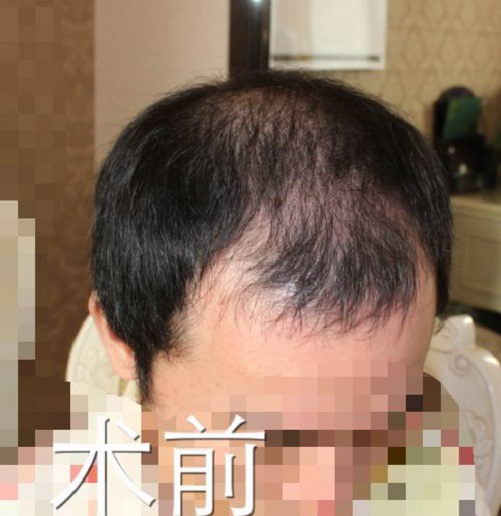 北京大麦植发技术靠谱吗？头发稀少不用怕，茂密重生有办法