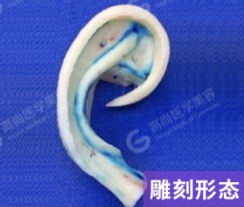 余文林：耳朵不完整在什么时候做手术最合适