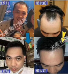 ��ɳ����΢��ֲ��ҽԺ�󲻹�ֲ��ǰ��ֲ������ʵ�Աȣ�