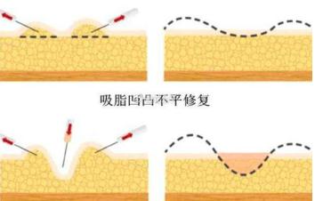吸脂失败在哪修复好,艾米丽专业修复医院为您解答