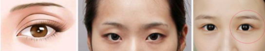 福州名韩整形徐丽丽：告诉你适合什么样的双眼皮？