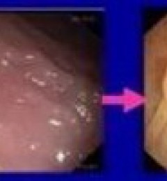 结直肠癌的高危人群预防和筛查指南广东民安医院主任提醒这些情况需注意