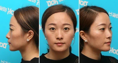 铜雀台整形医院赵兰明主任 自体脂肪填充 全城征集3000张少女脸