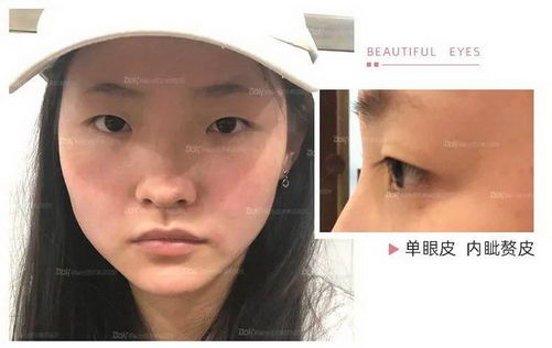 云南铜雀台刘哲延喜善美眼 专业的医生术前精心设计