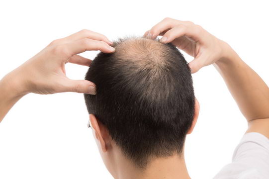 最新研究发现致秃关键 未来有望找出有效的防秃头治疗方法