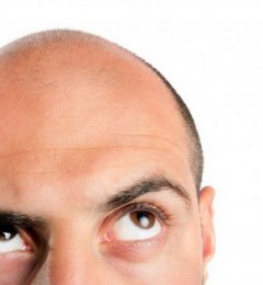 雄秃影响形象 药物综合治疗可有转机？