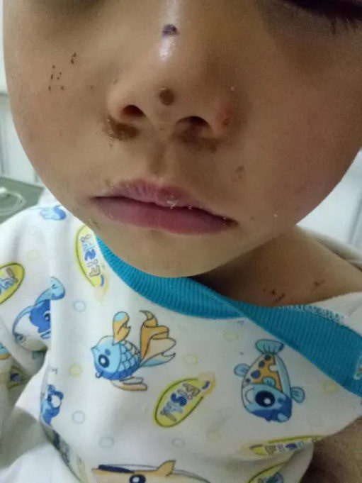 ŮͯƤ֢Ⱥ Ƥѿ鴹Σ