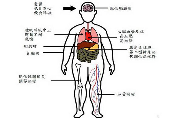 儿童肥胖也会引发心脏血管疾病、脂肪肝!家长学会9招战胜儿童肥胖