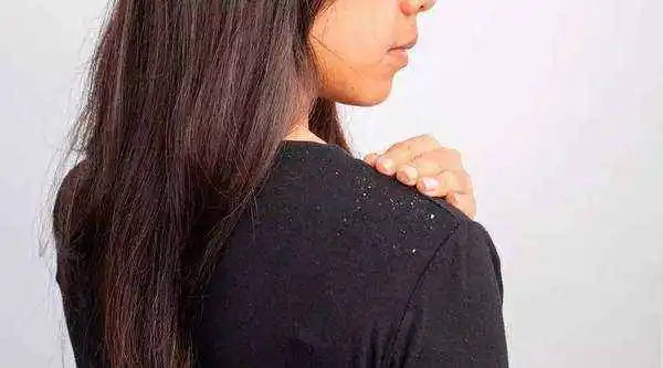 如何避免一头秀发“白雪纷飞”的尴尬