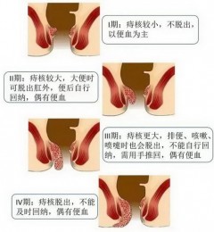 扬州妙手肛肠医院痔疮的治疗，需要注意一下这些症状