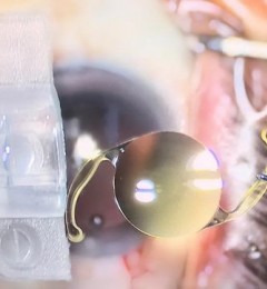 波前重塑EDoF人工晶体在东莞光明眼科医院成功植入