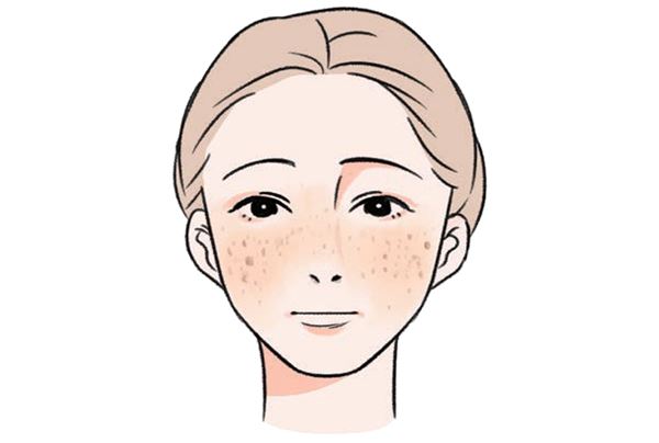 年纪轻轻肝斑找上门 应多吃“这类”食物